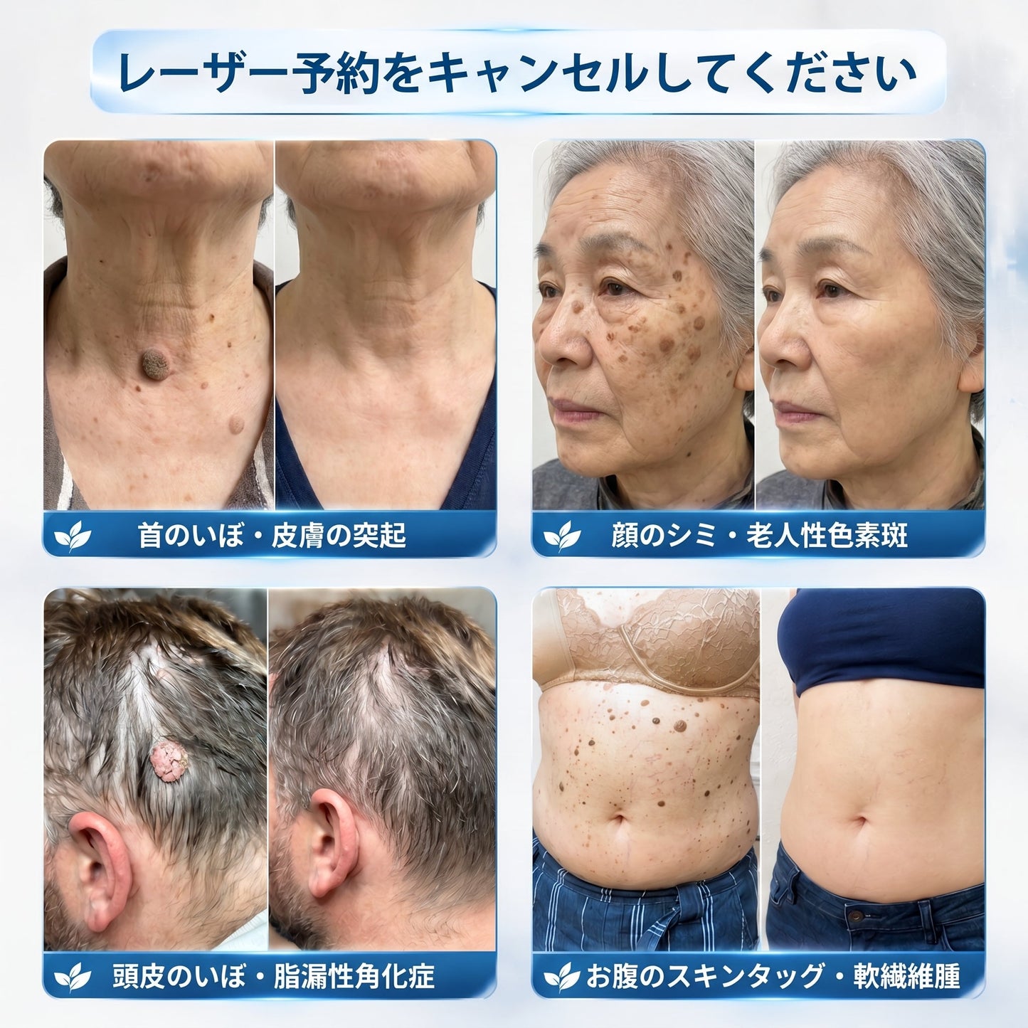 公式ショップ🐰𝐏i𝐜𝐝o® 7日間 シミ取り 傷跡ケア ペン(痛みゼロ、傷ゼロのローラーボール)💪