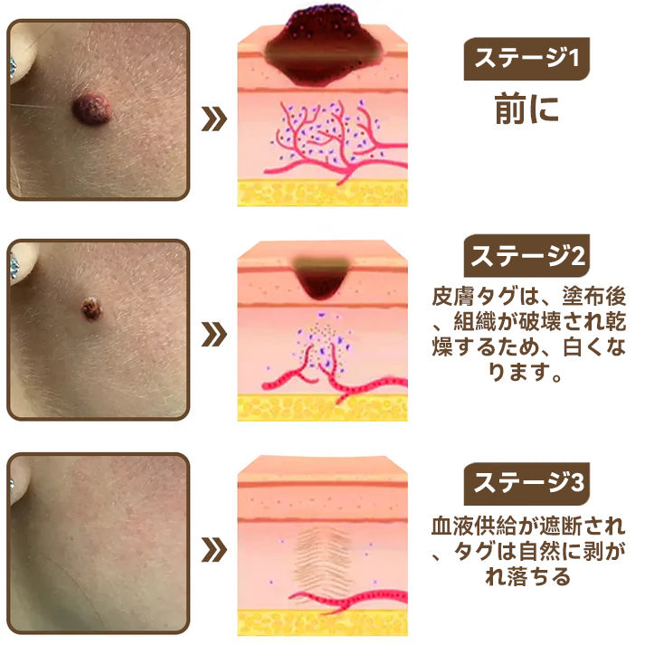 🌸🌸Diapason®:公式ストア 二重効果 植物の疣贅 除光クリーム 👩‍⚕️厚生労働省認定