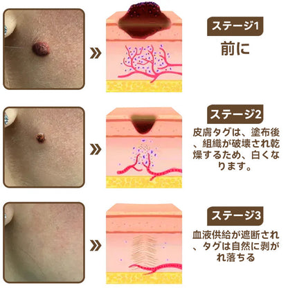 🌸🌸Diapason®:公式ストア 二重効果 植物の疣贅 除光クリーム 👩‍⚕️厚生労働省認定