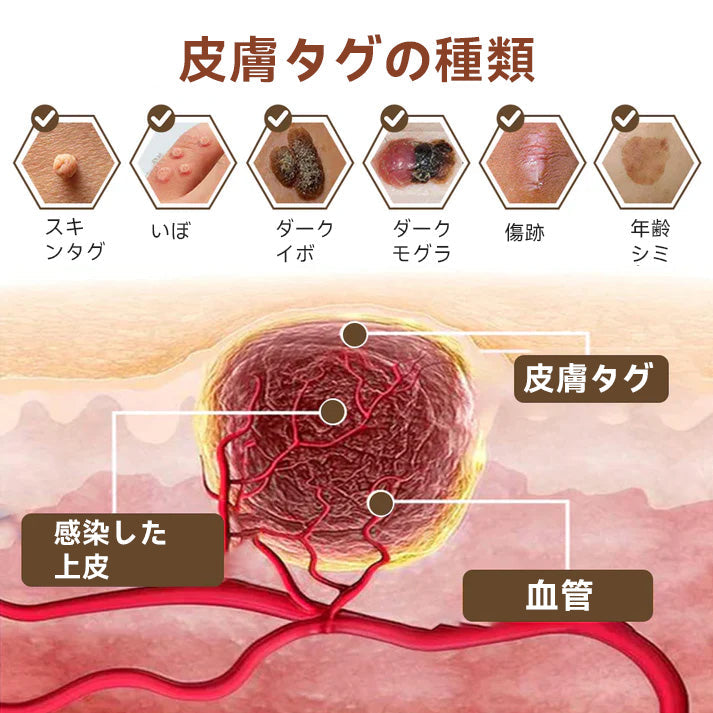 🌸🌸Diapason®:公式ストア 二重効果 植物の疣贅 除光クリーム 👩‍⚕️厚生労働省認定