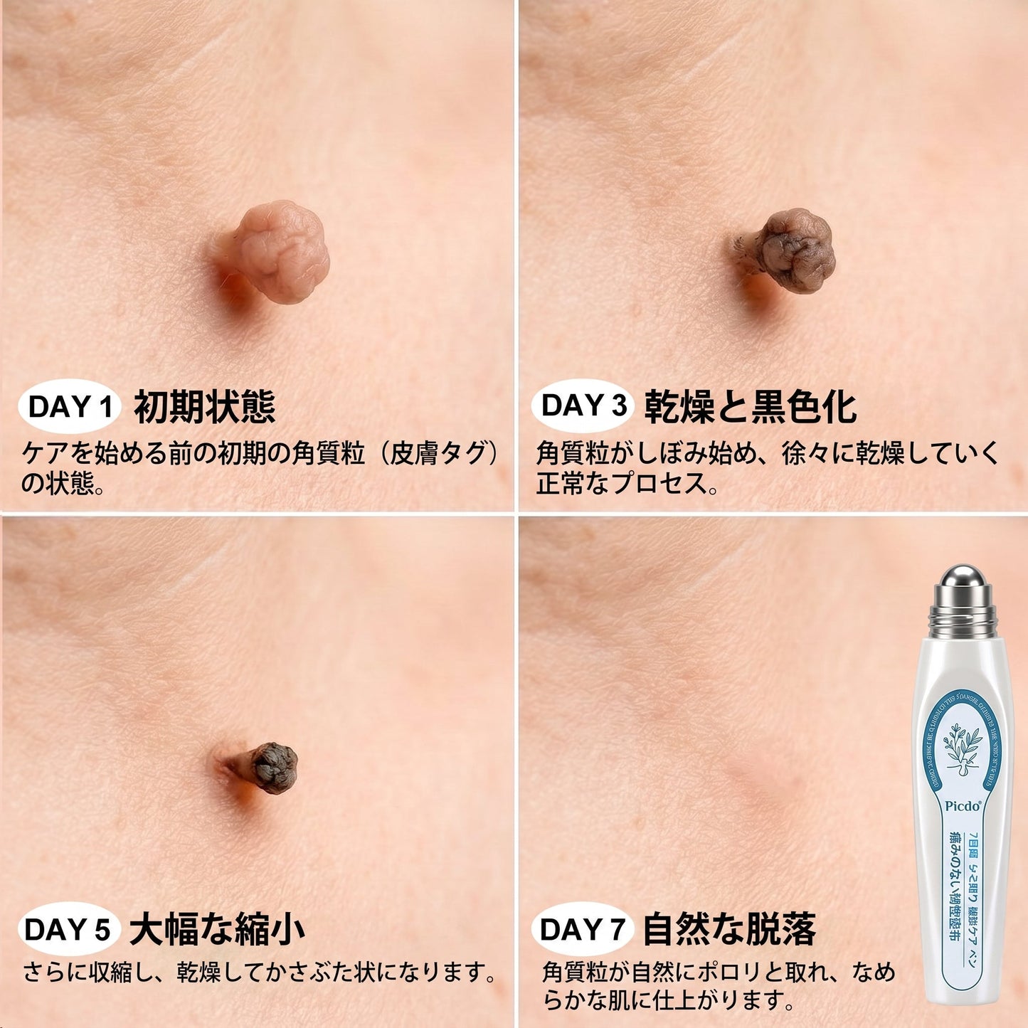 公式ショップ🐰𝐏i𝐜𝐝o® 7日間 シミ取り 傷跡ケア ペン(痛みゼロ、傷ゼロのローラーボール)💪