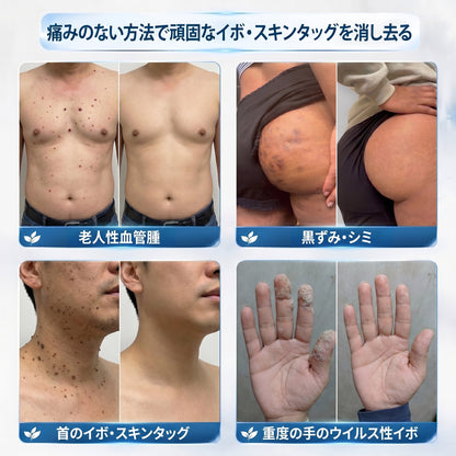 公式ショップ🐰𝐏i𝐜𝐝o® 7日間 シミ取り 傷跡ケア ペン(痛みゼロ、傷ゼロのローラーボール)💪